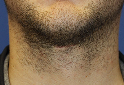 Tracheal Shave After Frontal