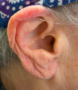 R Earlobe Reduction After